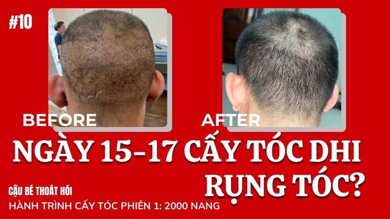 Ngày thứ 15-17 cấy tóc DHI chữa hói rụng tóc cấy? #10 l Hành Trình Cấy Tóc