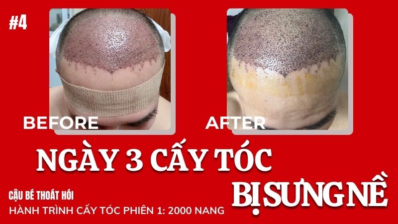 Ngày thứ 3 cấy tóc DHI chữa hói đầu bị sưng nề #4 l Hành Trình Cấy Tóc