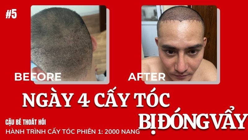 Ngày thứ 4 cấy tóc DHI chữa hói đóng vẩy có sao không? #5 l Hành Trình Cấy Tóc