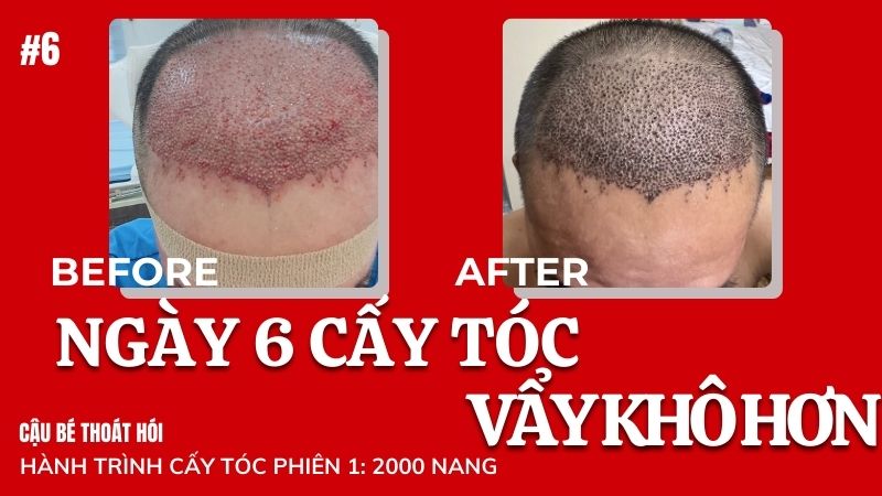 Ngày thứ 6 cấy tóc DHI chữa hói có đau không? #6 l Hành Trình Cấy Tóc