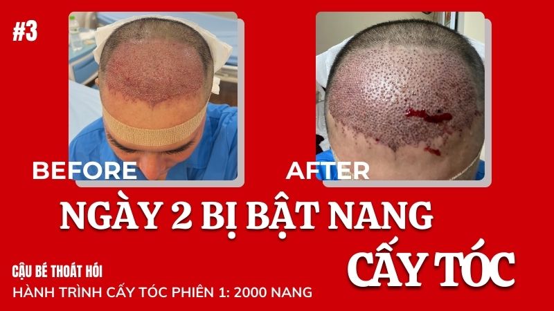 Ngày thứ hai cấy tóc DHI chữa hói đầu bị bật nang tóc #3 l Hành Trình Cấy Tóc