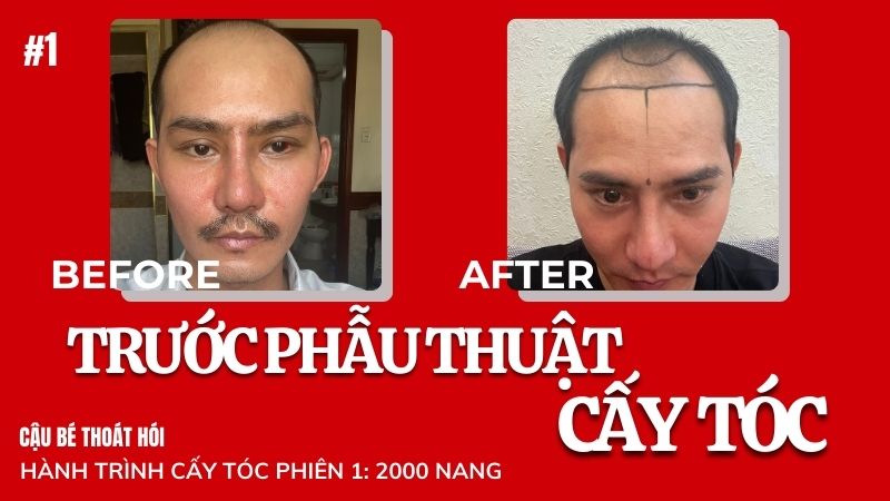 Trước khi cấy tóc DHI chữa hói đầu phiên 1 (2000 nang) #1 l Hành Trình Cấy Tóc
