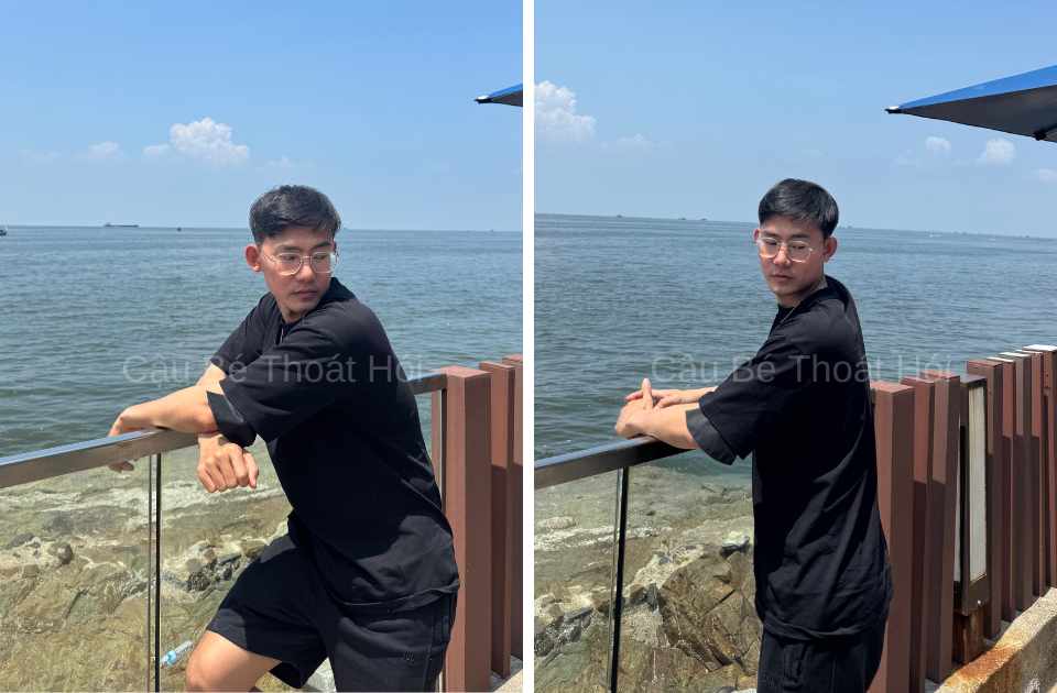 Kết Quả Cấy Tóc DHI Sau 2 Năm 1 Tháng (Tổng 5100 Nang) 1