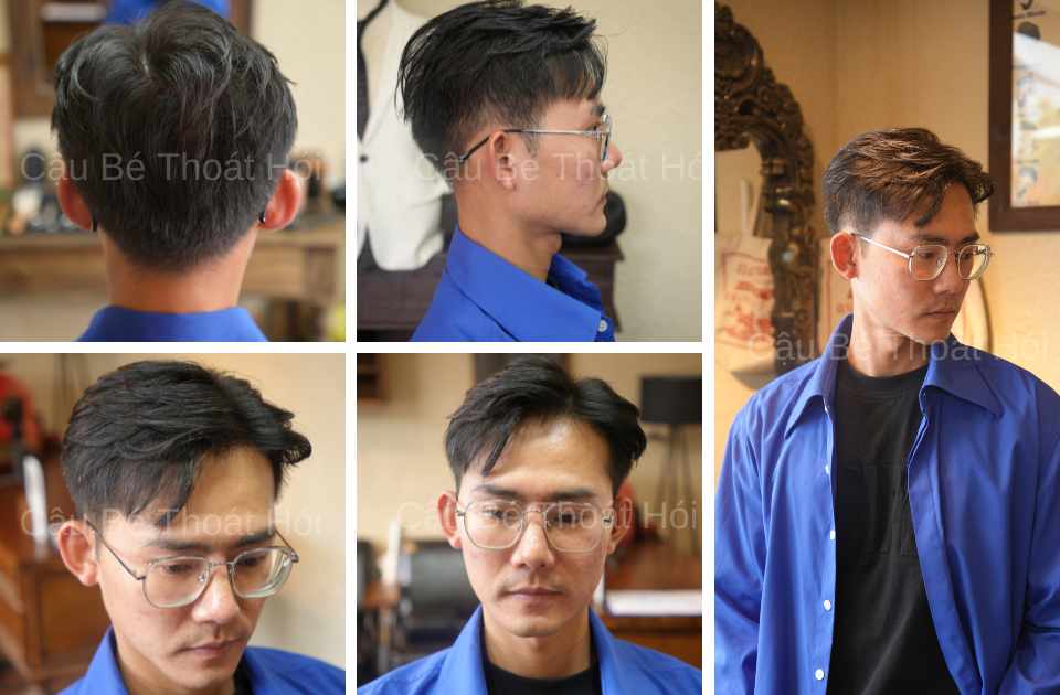 Kết Quả Cấy Tóc DHI Sau 2 Năm 1 Tháng (Tổng 5100 Nang) 1