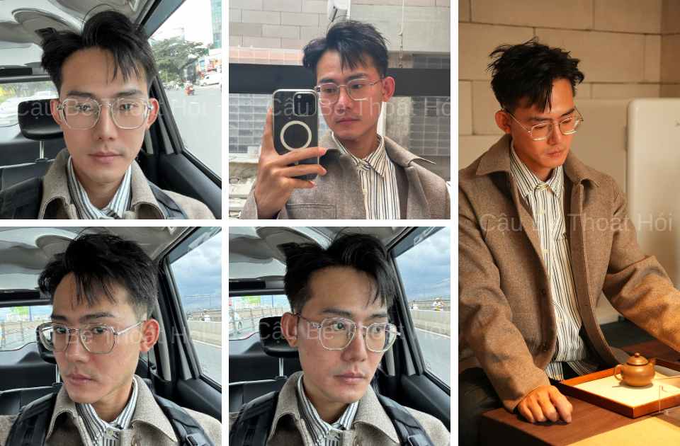 Kết Quả Cấy Tóc DHI Sau 2 Năm 2 Tháng chữa hói thành công