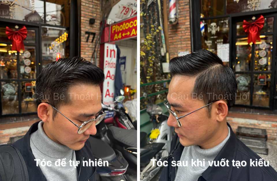 Kết Quả Cấy Tóc DHI Sau 2 Năm 3 Tháng chữa trị hói đầu thành công