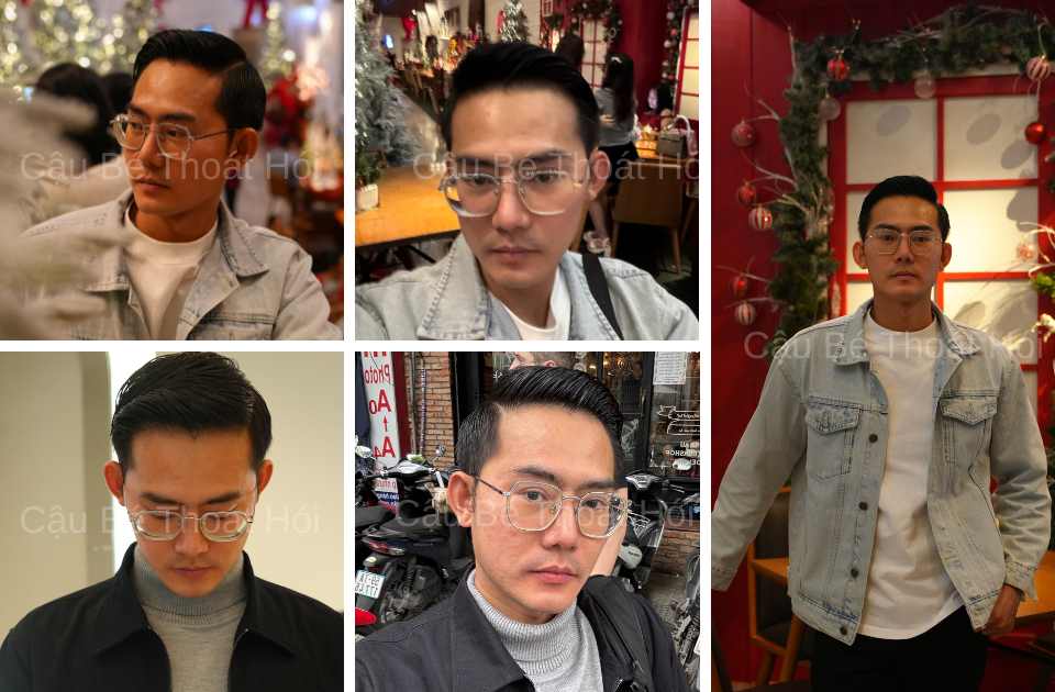 Kết Quả Cấy Tóc DHI Sau 2 Năm 3 Tháng hairline tóc chuẩn điện ảnh