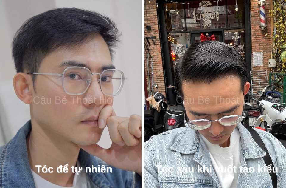 Kết Quả Cấy Tóc DHI Sau 2 Năm 3 Tháng tạo kiểu đẹp