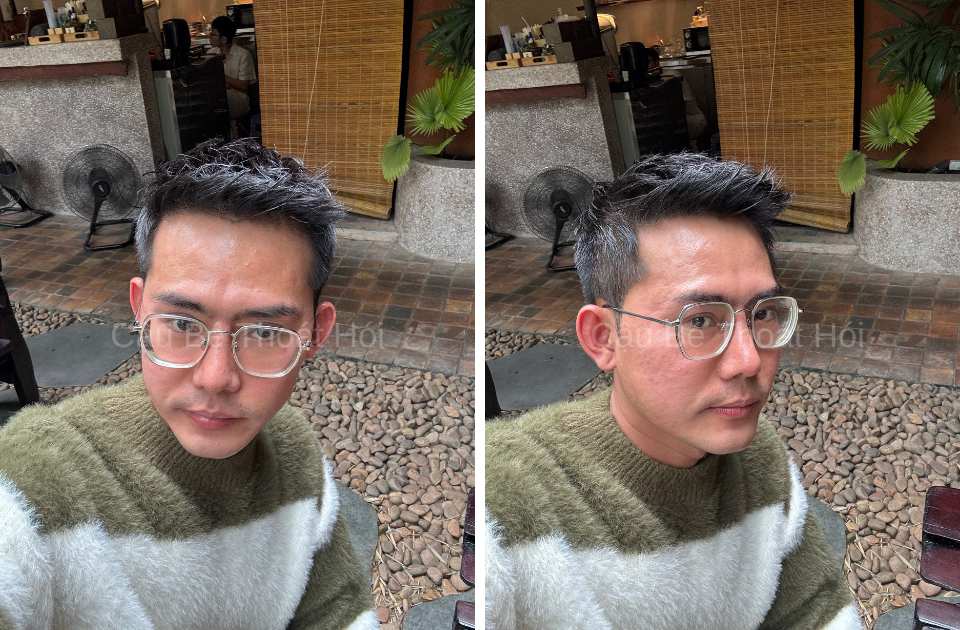 Kết Quả Cấy Tóc DHI Sau 2 Năm 3 Tháng tạo kiểu modern squiff