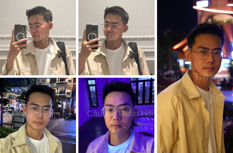 Kết Quả Cấy Tóc DHI Sau 2 Năm 3 Tháng thành công 100%