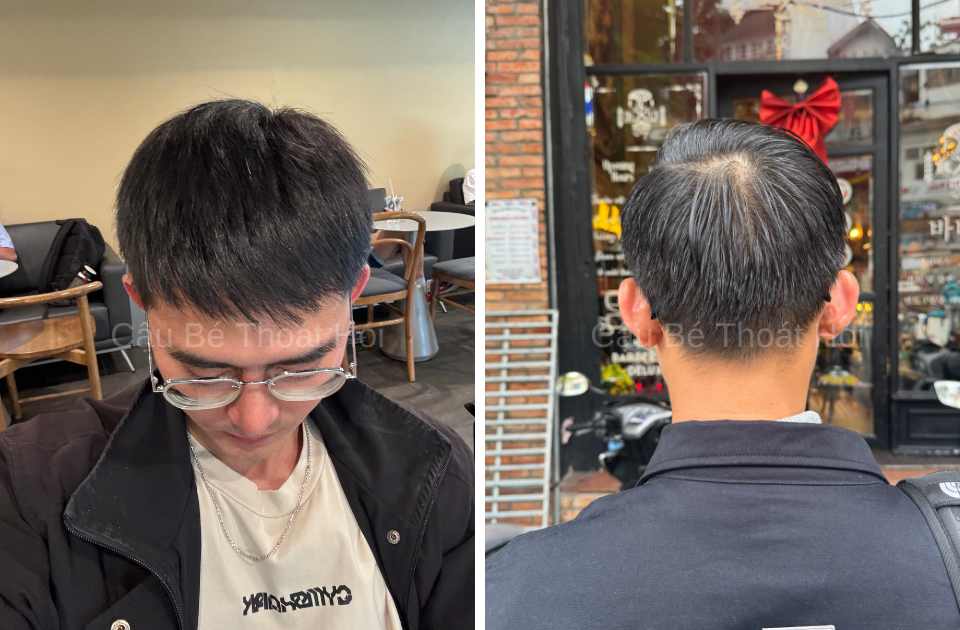 Kết Quả Cấy Tóc DHI Sau 2 Năm 3 Tháng