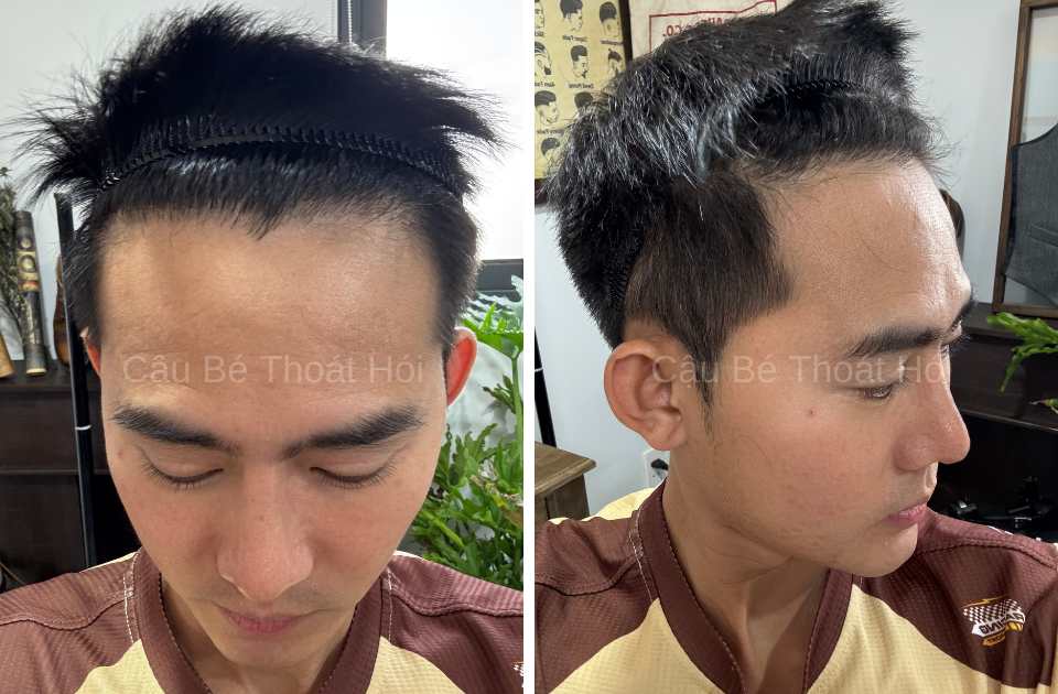 Kết Quả Cấy Tóc DHI Sau 2 Năm 4 Tháng line tóc rất tự nhiên và thẩm mỹ cao bởi tay nghề bác sĩ cấy tóc uy tín
