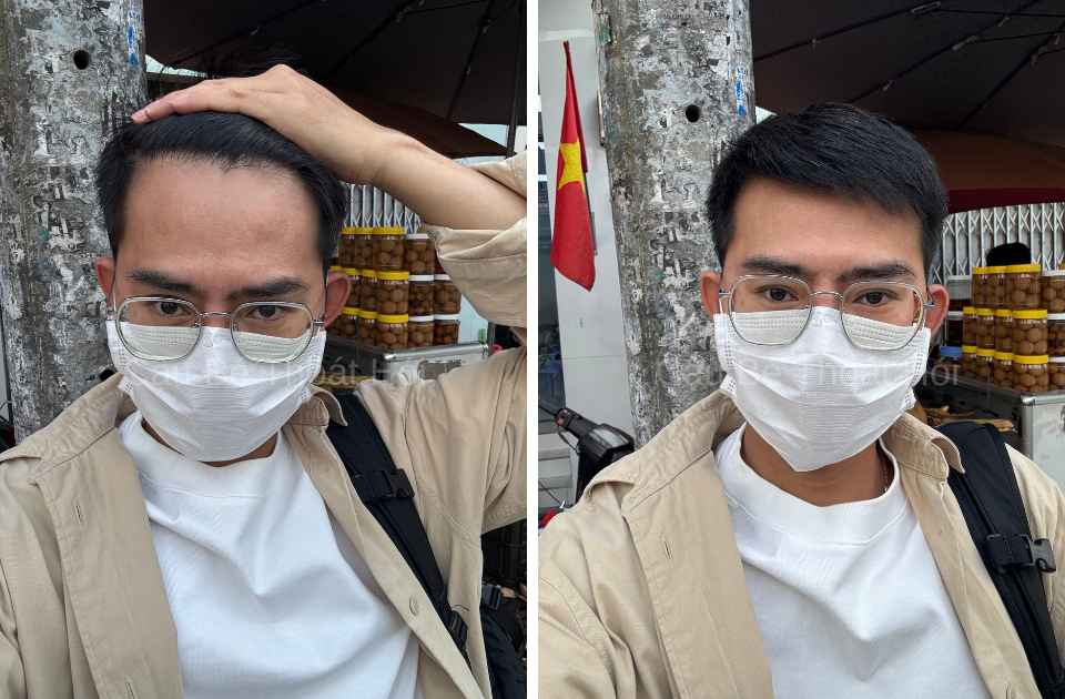 Kết Quả Cấy Tóc DHI Sau 2 Năm 4 Tháng tóc chắc khoẻ