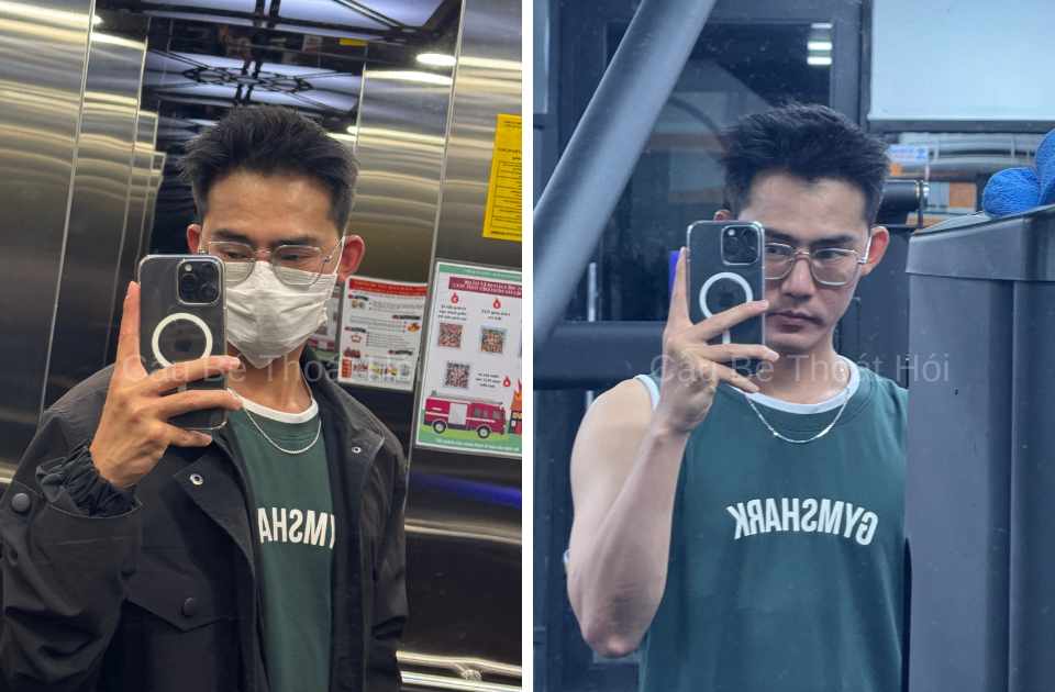 Kết Quả Cấy Tóc DHI Sau 2 Năm 4 Tháng tự tin trong cuộc sống