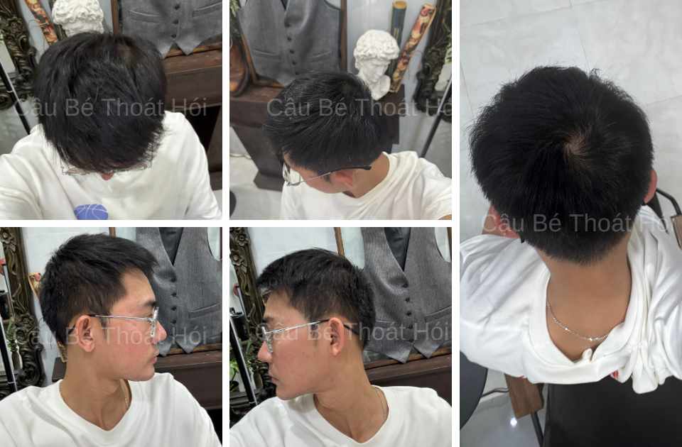 Kết Quả Cấy Tóc DHI Sau 2 Năm 4 Tháng vùng hiến nang và vùng cấy tóc