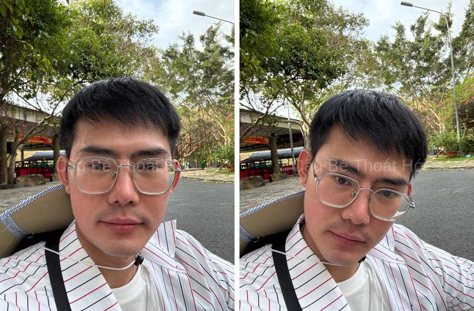 Kết Quả Cấy Tóc DHI Sau 2 Năm 5 Tháng tự tin đi làm không còn mặc cảm hói đầu