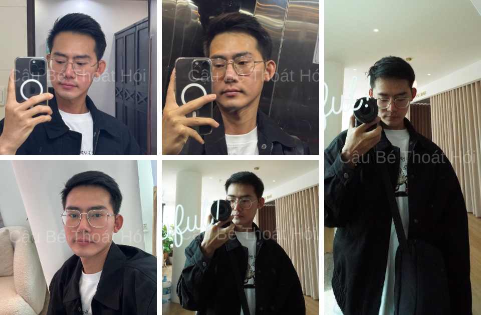 Kết Quả Cấy Tóc DHI Sau 2 Năm 5 Tháng tự tin trong sinh hoạt