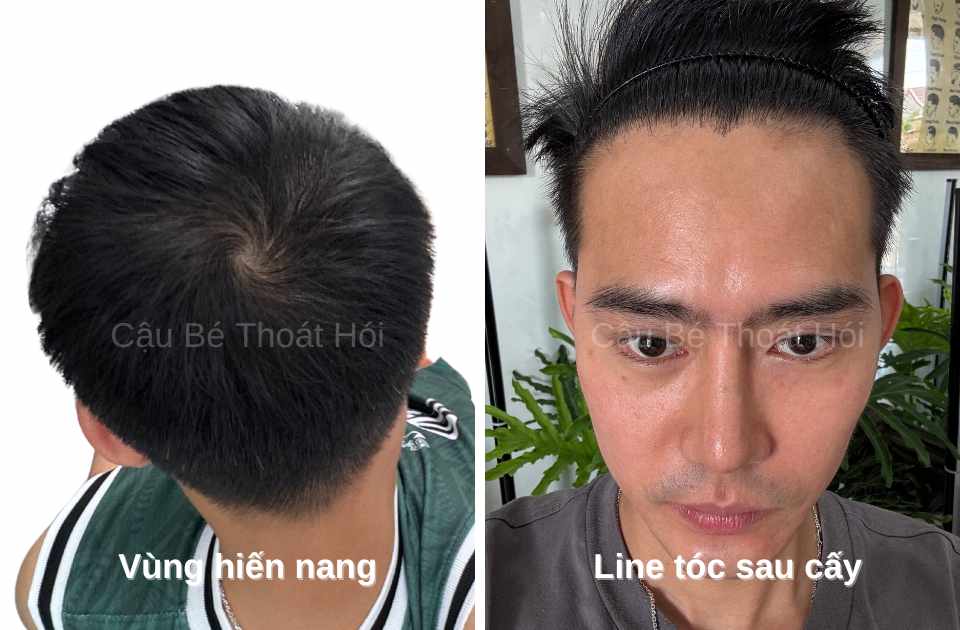 Kết Quả Cấy Tóc DHI Sau 2 Năm 5 Tháng vùng hiến nang và vùng cấy tóc