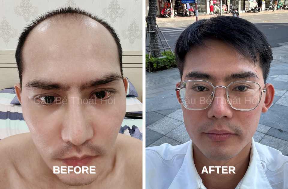 Kết Quả Cấy Tóc DHI Sau 2 Năm 6 Tháng chữa hói thành công