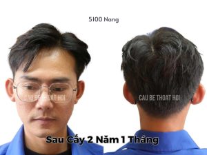 Kết Quả Cấy Tóc DHI Sau 2 năm 1 tháng 5100 Nang thành công