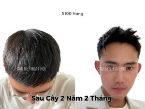 Kết Quả Cấy Tóc DHI Sau 2 năm 2 tháng 5100 Nang thành công