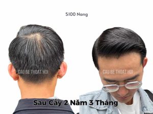 Kết Quả Cấy Tóc DHI Sau 2 năm 3 tháng 5100 Nang thành công