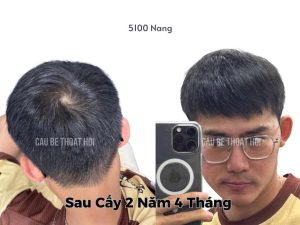Kết Quả Cấy Tóc DHI Sau 2 năm 4 tháng 5100 Nang thành công