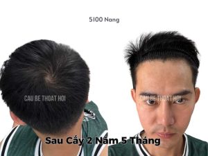 Kết Quả Cấy Tóc DHI Sau 2 năm 5 tháng 5100 Nang thành công