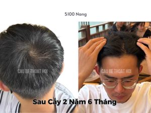 Kết Quả Cấy Tóc DHI Sau 2 năm 6 tháng 5100 Nang thành công