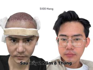 Kết Quả Cấy Tóc DHI Sau 3 Năm (Tổng 5100 Nang)