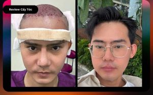 Review kết quả cấy tóc DHI sau 3 năm của cậu bé thoát hói