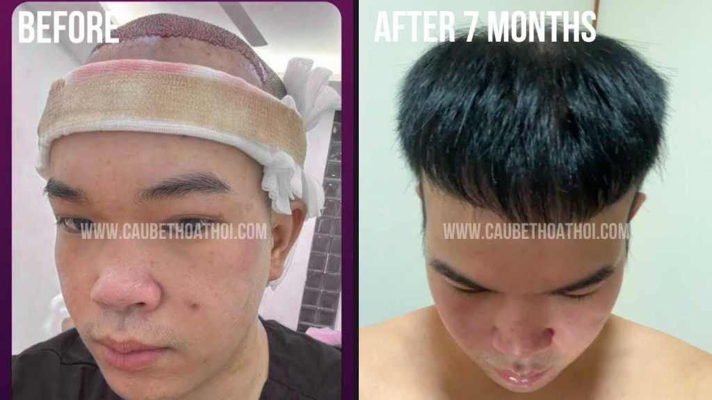 VĂN THANH VÀ KẾT QUẢ CẤY TÓC DHI THÀNH CÔNG