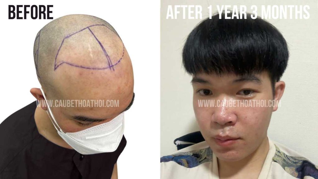 VĂN THANH VÀ KẾT QUẢ CẤY TÓC DHI THÀNH CÔNG