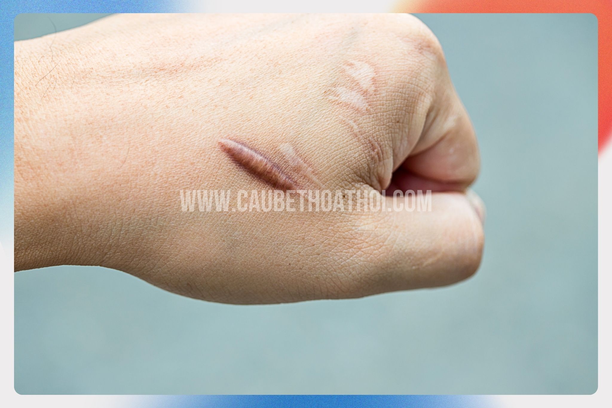 Cấy tóc khi dễ bị sẹo lồi