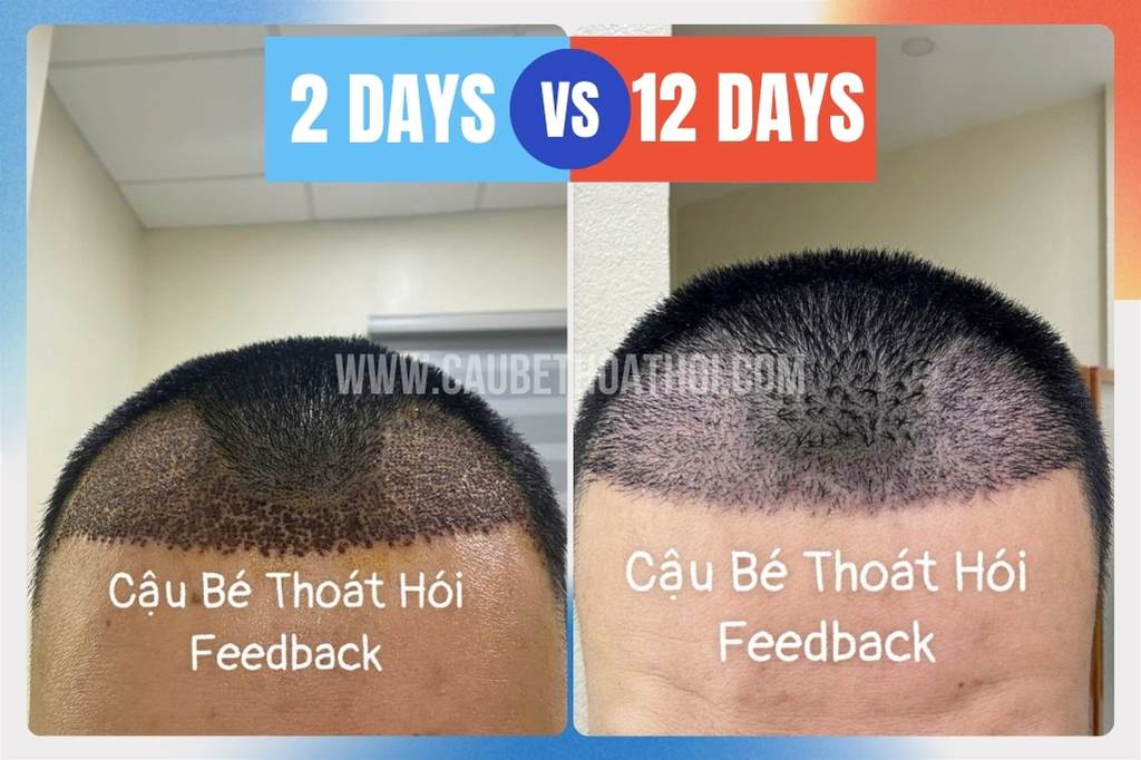 Hình ảnh da đầu sau 10-12 ngày cấy tóc 2200 nang vùng chữ M.