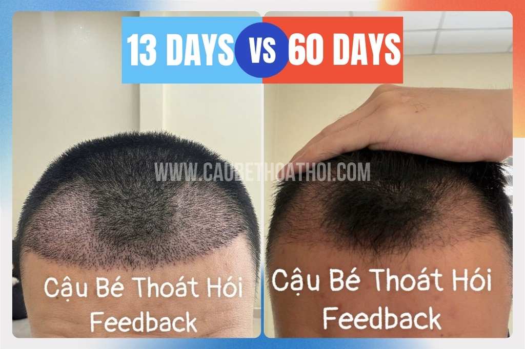 Giai đoạn rụng tóc lâm thời shock loss sau khi cấy tóc
