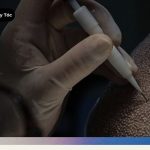 Giải đáp thắc mắc cấy tóc giữ được bao lâu và kết quả thực tế sau 1 năm