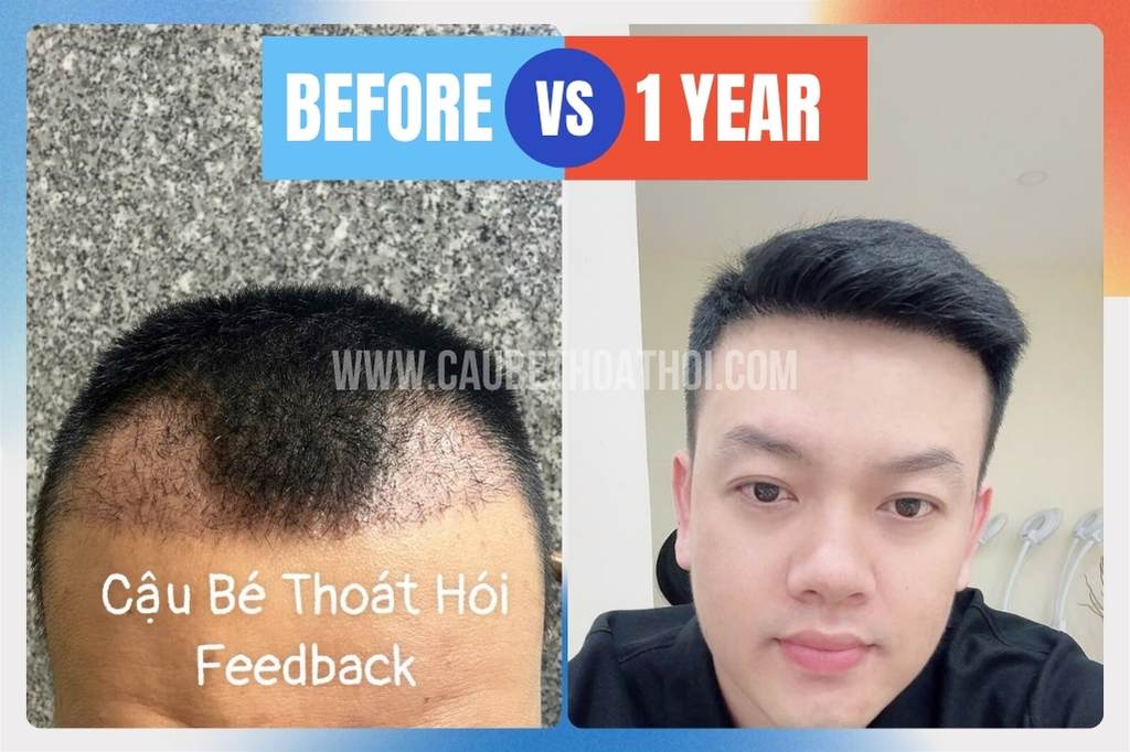Review cấy tóc 2200 nang tóc sau 1 năm đạt kết quả tự nhiên