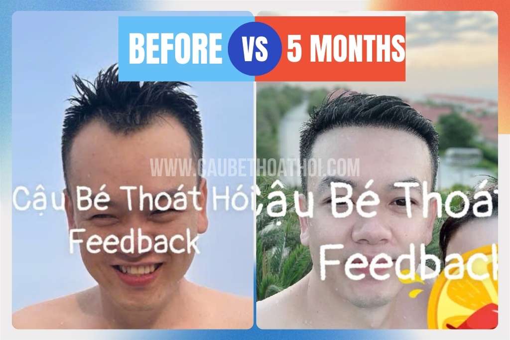 Sau 5 tháng cấy tóc kỹ thuật DHI thì tóc đã mọc che phủ tự tin hơn mặc dù chưa dày.