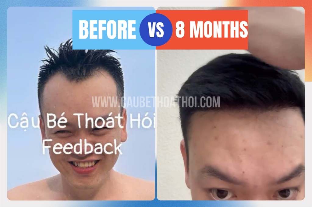 ật độ tóc mọc dày sau 8 tháng cấy tóc kỹ thuật DHI