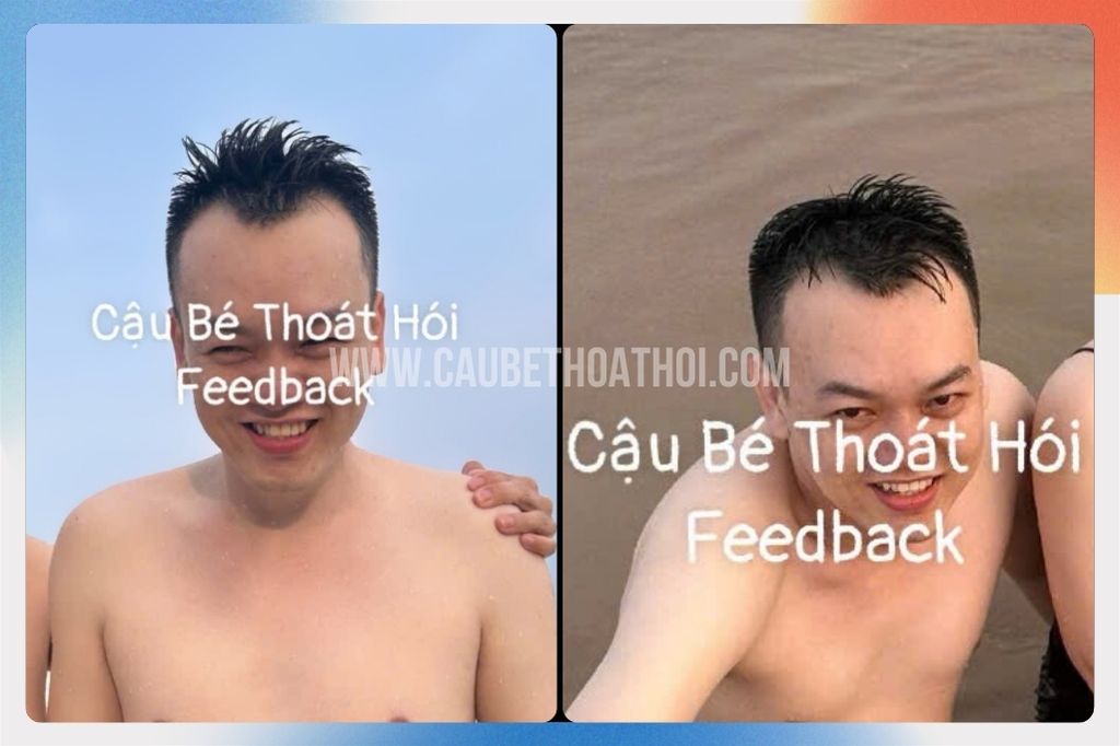 Tình trạng hói trán chữ M của anh Th H trước khi cấy tóc 2200 nang