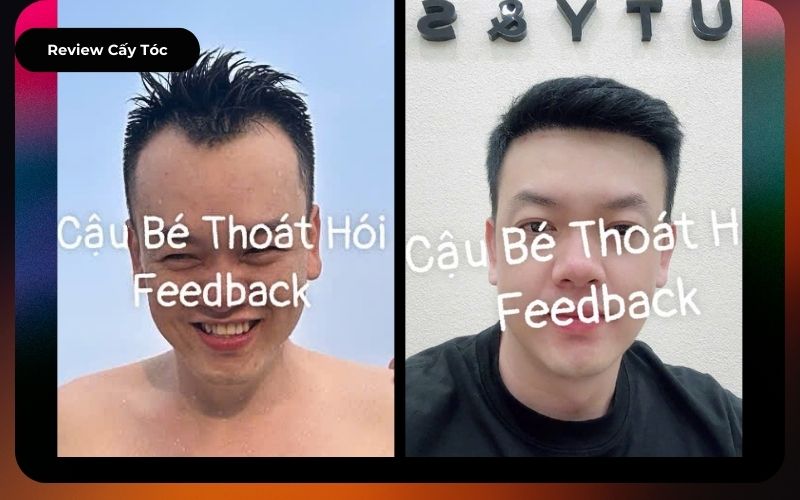 Kết quả cấy tóc 2200 nang tóc cho anh Th. H. tại Long An