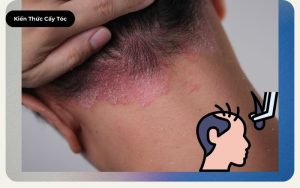 Bị vảy nến da đầu có cấy tóc được không và những lưu ý
