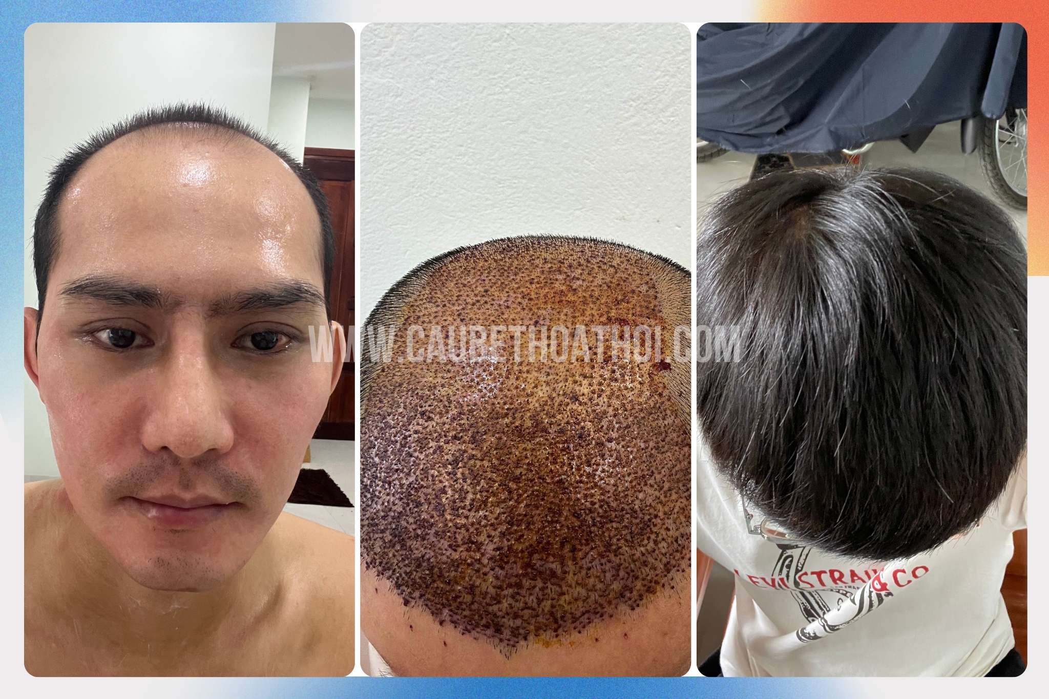 Hình ảnh hói đỉnh đầu trước khi cấy tóc, sau cấy và kết quả phục hồi tóc vùng đỉnh đầu