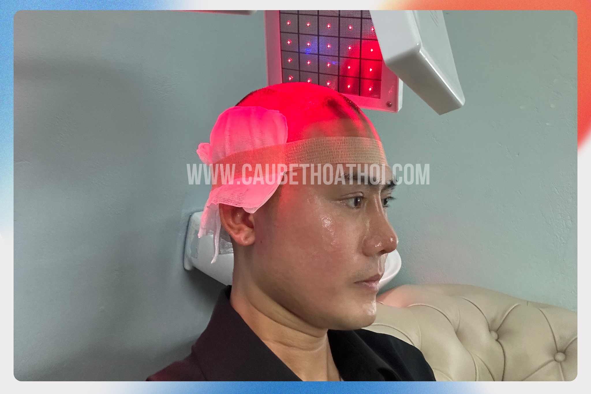 Hình ảnh chăm sóc sau cấy tóc giúp tăng tỷ lệ sống của nang tóc cấy ghép