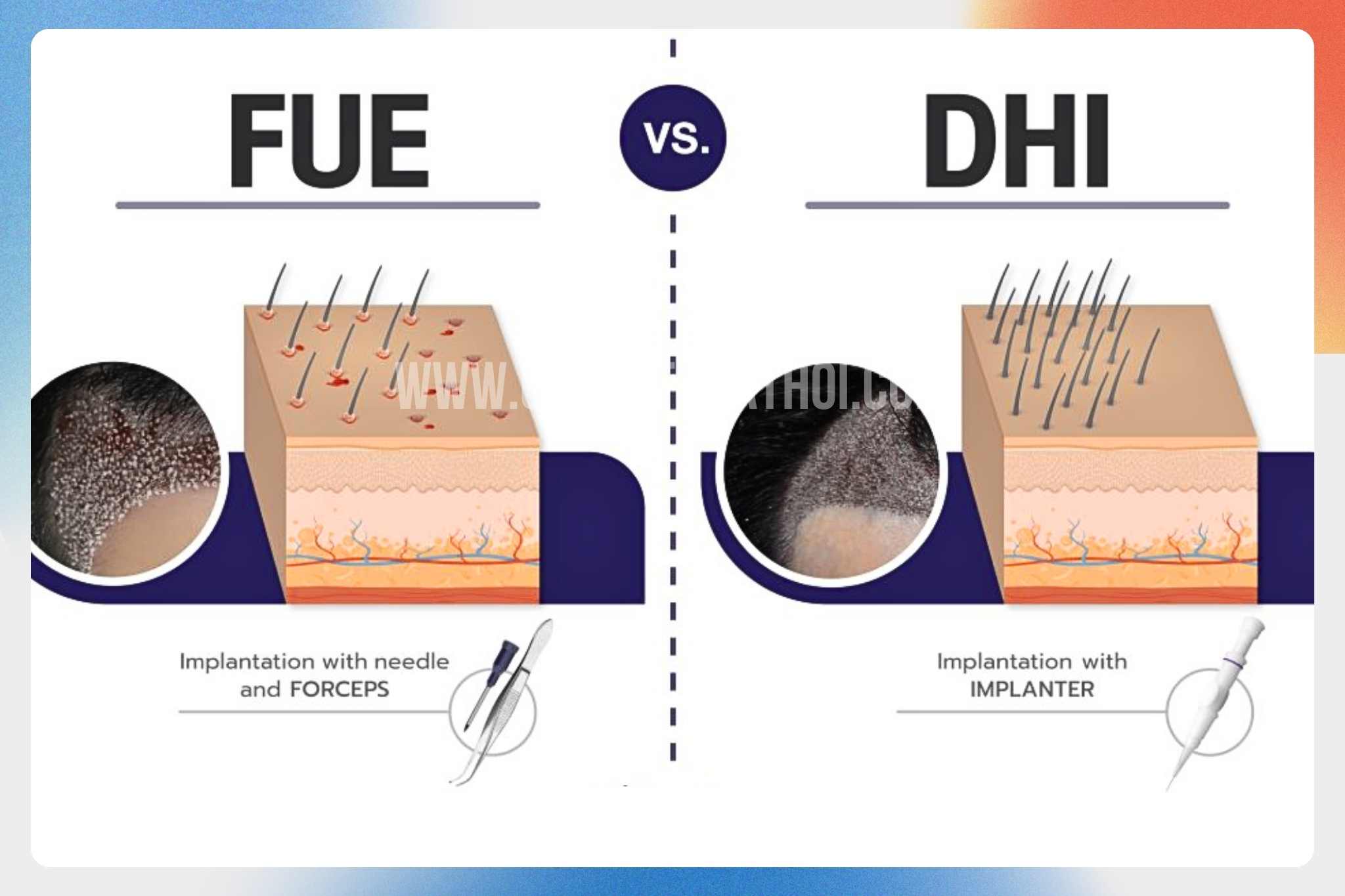 Hình ảnh so sánh kỹ thuật cấy tóc FUE và DHI ảnh hưởng đến tỷ lệ sống của nang tóc