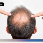 Tỷ lệ thành công của cấy tóc hiện nay là bao nhiêu? Tìm hiểu tỷ lệ sống của nang tóc, kỹ thuật DHI và FUE cùng kết quả thực tế sau cấy tóc.