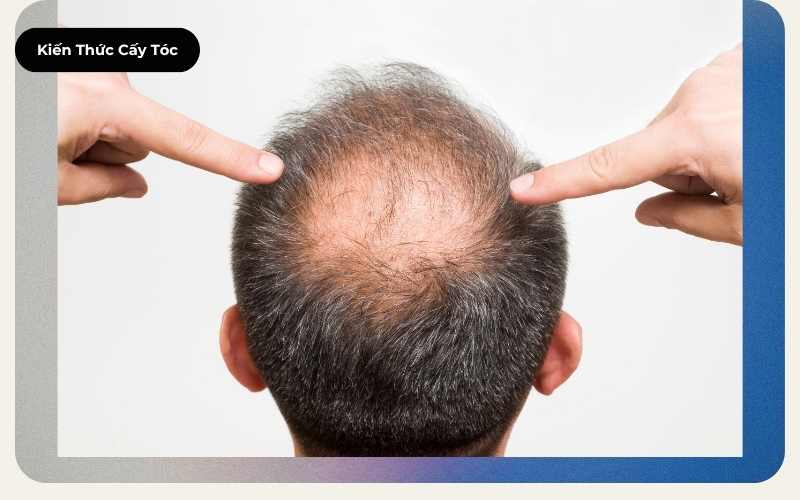 Tỷ lệ thành công của cấy tóc hiện nay là bao nhiêu? Tìm hiểu tỷ lệ sống của nang tóc, kỹ thuật DHI và FUE cùng kết quả thực tế sau cấy tóc.
