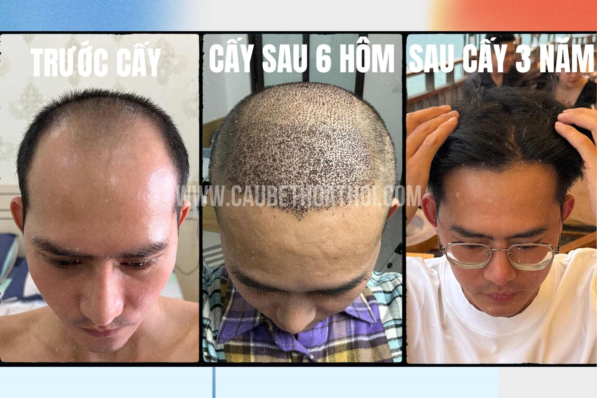 Kết quả thực tế cho thấy tỷ lệ thành công của cấy tóc sau 3 năm với mật độ tóc tự nhiên