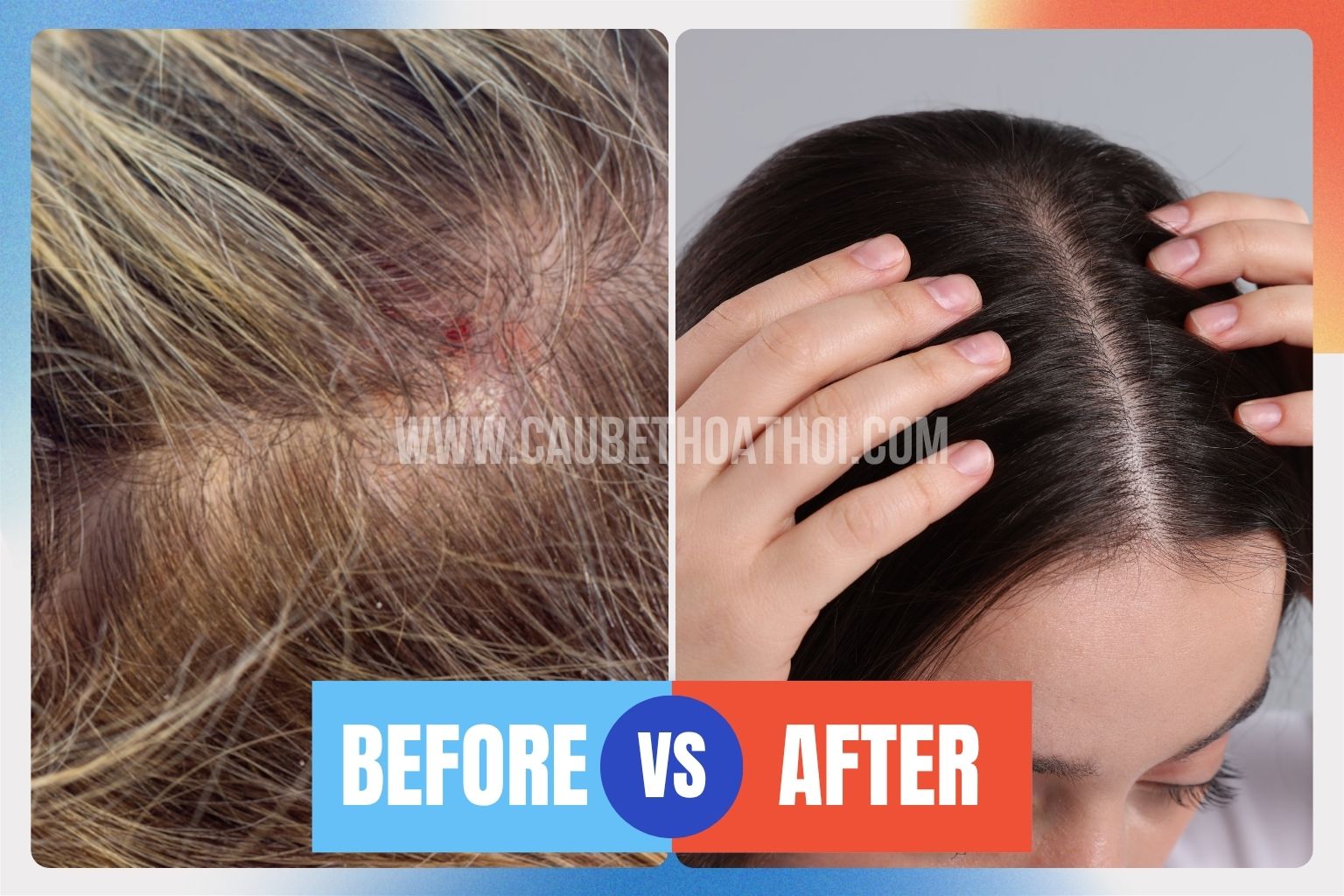 Hình ảnh da đầu bùng phát viêm da tiết bã cần hoãn cấy tóc và da đầu khỏe mạnh đủ điều kiện phẫu thuật